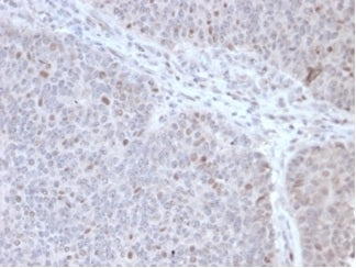 IHC staining of FFPE human lymphoma tissue with POLE3 antibody (clone PCRP-POLE3-2F10) at 2ug/ml. HIER: boil tissue sections in pH 9 10mM Tris with 1mM EDTA for 20 min and allow to cool before testing.