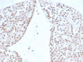 IHC staining of FFPE human renal oncocytoma with recombinant Steroidogenic Factor 1 antibody (clone rNR5A1/4369). HIER: boil tissue sections in pH 9 10mM Tris with 1mM EDTA for 20 min and allow to cool before testing.