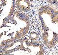 Immunohistochemical staining of HTR3E using anti-HTR3E antibody. HTR3E was detected in a paraffin-embedded section of human colon cancer tissue. Heat mediated antigen retrieval was performed in EDTA buffer (pH 8.0, epitope retrieval solution). The tissue section was blocked with 10% goat serum. The tissue section was then incubated with 2 ug/ml rabbit anti-HTR3E antibody overnight at 4oC. Peroxidase Conjugated Goat Anti-rabbit IgG was used as secondary antibody and incubated for 30 min at 37oC.