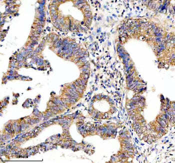 Immunohistochemical staining of HTR3E using anti-HTR3E antibody. HTR3E was detected in a paraffin-embedded section of human colon cancer tissue. Heat mediated antigen retrieval was performed in EDTA buffer (pH 8.0, epitope retrieval solution). The tissue section was blocked with 10% goat serum. The tissue section was then incubated with 2 ug/ml rabbit anti-HTR3E antibody overnight at 4oC. Peroxidase Conjugated Goat Anti-rabbit IgG was used as secondary antibody and incubated for 30 min at 37oC.