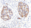 Immunohistochemical staining of LRG1 using anti-LRG1 antibody. LRG1 was detected in a paraffin-embedded section of human pancreas cancer tissue. Heat mediated antigen retrieval was performed in EDTA buffer (pH 8.0, epitope retrieval solution). The tissue section was blocked with 10% goat serum. The tissue section was then incubated with 2 ug/ml rabbit anti-LRG1 antibody overnight at 4oC. Peroxidase Conjugated Goat Anti-rabbit IgG was used as secondary antibody and incubated for 30 min at 37oC.