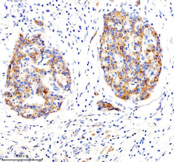 Immunohistochemical staining of LRG1 using anti-LRG1 antibody. LRG1 was detected in a paraffin-embedded section of human pancreas cancer tissue. Heat mediated antigen retrieval was performed in EDTA buffer (pH 8.0, epitope retrieval solution). The tissue section was blocked with 10% goat serum. The tissue section was then incubated with 2 ug/ml rabbit anti-LRG1 antibody overnight at 4oC. Peroxidase Conjugated Goat Anti-rabbit IgG was used as secondary antibody and incubated for 30 min at 37oC.