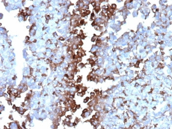 IHC staining of FFPE human adrenal gland tissue with Apolipoprotein J antibody (clone CLU/4737). Inset: PBS used in place of primary Ab (secondary Ab negative control). HIER: boil tissue sections in pH 9 10mM Tris with 1mM EDTA for 20 min and allow to cool before testing.