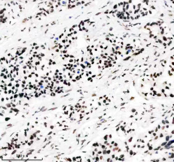 IHC staining of FFPE human lung cancer tissue with PABPN1 antibody, HRP-secondary and DAB substrate. HIER: boil tissue sections in pH8 EDTA for 20 min and allow to cool before testing.