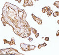 Immunohistochemical staining of GNAI2 using anti-GNAI2 antibody. GNAI2 was detected in a paraffin-embedded section of human liver cancer tissue. Heat mediated antigen retrieval was performed in EDTA buffer (pH 8.0, epitope retrieval solution). The tissue section was blocked with 10% goat serum. The tissue section was then incubated with 2 ug/ml rabbit anti-GNAI2 antibody overnight at 4oC. Peroxidase Conjugated Goat Anti-rabbit IgG was used as secondary antibody and incubated for 30 min at 37oC.