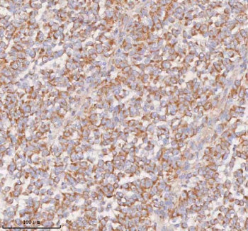 Immunohistochemical staining of SLC14A1 using anti-SLC14A1 antibody. SLC14A1 was detected in a paraffin-embedded section of human pancreatic cancer tissue. Heat mediated antigen retrieval was performed in EDTA buffer (pH 8.0, epitope retrieval solution). The tissue section was blocked with 10% goat serum. The tissue section was then incubated with 2 ug/ml rabbit anti-SLC14A1 antibody overnight at 4oC. Peroxidase Conjugated Goat Anti-rabbit IgG was used as secondary antibody and incubated for 30 min at 37oC.