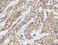 IHC analysis of RAB27B using anti-RAB27B antibody. RAB27B was detected in a paraffin-embedded section of human prostatic cancer tissue. Heat mediated antigen retrieval was performed in EDTA buffer (pH 8.0, epitope retrieval solution). The tissue section was blocked with 10% goat serum. The tissue section was then incubated with 2 ug/ml rabbit anti-RAB27B antibody overnight at 4oC. Peroxidase Conjugated Goat Anti-rabbit IgG was used as secondary antibody and incubated for 30 min at 37oC.