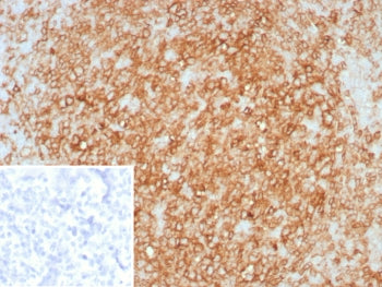 IHC staining of FFPE human tonsil tissue with HLA-DR antibody (clone rHLA-DRA/8285). Inset: PBS used in place of primary Ab (secondary Ab negative control). HIER: boil tissue sections in pH 9 10mM Tris with 1mM EDTA for 20 min and allow to cool before testing.