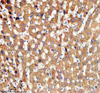 Immunohistochemical staining of TDO2 using anti-TDO2 antibody. TDO2 was detected in a paraffin-embedded section of human liver cancer tissue. Heat mediated antigen retrieval was performed in EDTA buffer (pH 8.0, epitope retrieval solution). The tissue section was blocked with 10% goat serum. The tissue section was then incubated with 2 ug/ml rabbit anti-TDO2 antibody overnight at 4oC. Peroxidase Conjugated Goat Anti-rabbit IgG was used as secondary antibody and incubated for 30 min at 37oC.