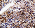 IHC staining of FFPE human lung cancer tissue with DDT antibody. HIER: boil tissue sections in pH6, 10mM citrate buffer, for 20 min and allow to cool before testing.