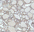 Immunohistochemical staining of IDH3B using anti-IDH3B antibody. IDH3B was detected in a paraffin-embedded section of follicles of human thyroid cancer tissue. Heat mediated antigen retrieval was performed in EDTA buffer (pH 8.0, epitope retrieval solution). The tissue section was blocked with 10% goat serum. The tissue section was then incubated with 2 ug/ml rabbit anti-IDH3B antibody overnight at 4oC.