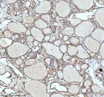 Immunohistochemical staining of IDH3B using anti-IDH3B antibody. IDH3B was detected in a paraffin-embedded section of follicles of human thyroid cancer tissue. Heat mediated antigen retrieval was performed in EDTA buffer (pH 8.0, epitope retrieval solution). The tissue section was blocked with 10% goat serum. The tissue section was then incubated with 2 ug/ml rabbit anti-IDH3B antibody overnight at 4oC.