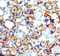 IHC analysis of SEC63 using anti-SEC63 antibody. SEC63 was detected in a paraffin-embedded section of human thyroid cancer tissue. Heat mediated antigen retrieval was performed in EDTA buffer (pH 8.0, epitope retrieval solution). The tissue section was blocked with 10% goat serum. The tissue section was then incubated with 2 ug/ml rabbit anti-SEC63 antibody overnight at 4oC. Peroxidase Conjugated Goat Anti-rabbit IgG was used as secondary antibody and incubated for 30 min at 37oC.