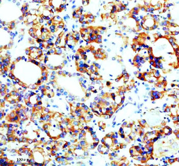 IHC analysis of SEC63 using anti-SEC63 antibody. SEC63 was detected in a paraffin-embedded section of human thyroid cancer tissue. Heat mediated antigen retrieval was performed in EDTA buffer (pH 8.0, epitope retrieval solution). The tissue section was blocked with 10% goat serum. The tissue section was then incubated with 2 ug/ml rabbit anti-SEC63 antibody overnight at 4oC. Peroxidase Conjugated Goat Anti-rabbit IgG was used as secondary antibody and incubated for 30 min at 37oC.