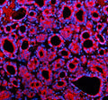 Immunofluorescent staining of SHE using anti-SHE antibody (red). SHE was detected in a paraffin-embedded section of human thyroid cancer tissue. Heat mediated antigen retrieval was performed in EDTA buffer (pH 8.0, epitope retrieval solution). The tissue section was blocked with 10% goat serum. The tissue section was then incubated with 5 ug/ml rabbit anti-SHE antibody overnight at 4oC. Cy3 Conjugated Goat Anti-Rabbit IgG was used as secondary antibody at 1:500 dilution and incubated for 30 min at 37oC.