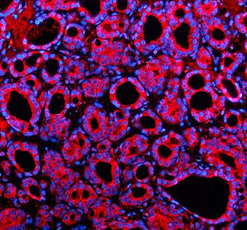 Immunofluorescent staining of SHE using anti-SHE antibody (red). SHE was detected in a paraffin-embedded section of human thyroid cancer tissue. Heat mediated antigen retrieval was performed in EDTA buffer (pH 8.0, epitope retrieval solution). The tissue section was blocked with 10% goat serum. The tissue section was then incubated with 5 ug/ml rabbit anti-SHE antibody overnight at 4oC. Cy3 Conjugated Goat Anti-Rabbit IgG was used as secondary antibody at 1:500 dilution and incubated for 30 min at 37oC.