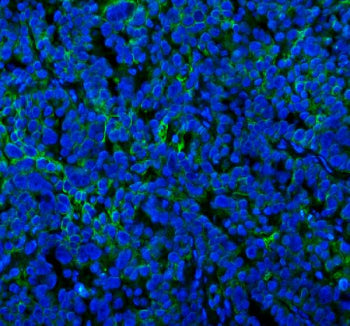 Immunofluorescent staining of SPA17 using anti-SPA17 antibody (green). SPA17 was detected in a paraffin-embedded section of human cervical cancer tissue. Heat mediated antigen retrieval was performed in EDTA buffer (pH 8.0, epitope retrieval solution). The tissue section was blocked with 10% goat serum. The tissue section was then incubated with 5 ug/ml rabbit anti-SPA17 antibody overnight at 4oC.