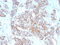 IHC staining of FFPE human breast carcinoma tissue with recombinant HER-2 antibody (clone rERBB2/9401). HIER: boil tissue sections in pH 9 10mM Tris with 1mM EDTA for 20 min and allow to cool before testing.