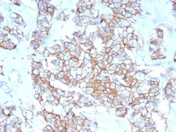 IHC staining of FFPE human breast carcinoma tissue with recombinant HER-2 antibody (clone rERBB2/9401). HIER: boil tissue sections in pH 9 10mM Tris with 1mM EDTA for 20 min and allow to cool before testing.