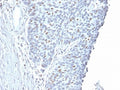 IHC testing of FFPE human endometrial carcinoma with Cyclin A2 antibody. Required HIER: steam section in pH6 citrate buffer for 20 min and allow to cool prior to staining.