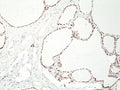 IHC staining of FFPE human thyroid tissue with recombinant PAX8 antibody at 1:400.