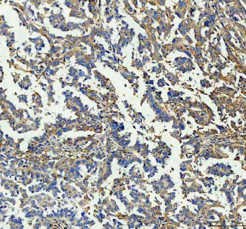 Immunohistochemical staining of GBP1 using anti-GBP1 antibody. GBP1 was detected in a paraffin-embedded section of human ovarian cancer tissue. Heat mediated antigen retrieval was performed in EDTA buffer (pH 8.0, epitope retrieval solution). The tissue section was blocked with 10% goat serum. The tissue section was then incubated with 2 ug/ml rabbit anti-GBP1 antibody overnight at 4oC. Peroxidase Conjugated Goat Anti-rabbit IgG was used as secondary antibody and incubated for 30 minutes at 37oC. The tissue