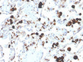 IHC staining of FFPE human lung adenocarcinoma with Napsin A antibody (clone NAPSA/3305). HIER: boil tissue sections in pH 9 10mM Tris with 1mM EDTA for 20 min and allow to cool before testing.