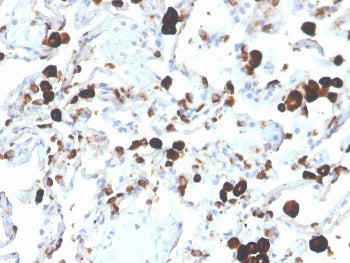 IHC staining of FFPE human lung adenocarcinoma with Napsin A antibody (clone NAPSA/3305). HIER: boil tissue sections in pH 9 10mM Tris with 1mM EDTA for 20 min and allow to cool before testing.