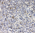IHC staining of FFPE human glioma tissue with uPAR antibody. HIER: boil tissue sections in pH8 EDTA for 20 min and allow to cool before testing.