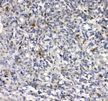 IHC staining of FFPE human glioma tissue with uPAR antibody. HIER: boil tissue sections in pH8 EDTA for 20 min and allow to cool before testing.
