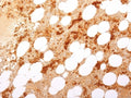 IHC staining of FFPE human bone marrow with recombinant CD71 antibody (clone TFRC/2898R). HIER: boil tissue sections in pH 9 10mM Tris with 1mM EDTA for 20 min and allow to cool before testing.