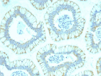 IHC staining of FFPE human colon carcinoma with SMAD4 antibody (clone SMAD4/2440). HIER: boil tissue sections in pH 9 10mM Tris with 1mM EDTA for 20 min and allow to cool before testing.
