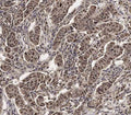 IHC staining of FFPE human breast carcinoma tissue with SCXA antibody. HIER: steam section in pH6 citrate buffer for 20 min and allow to cool prior to staining.