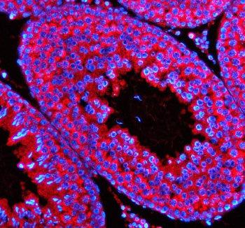 Immunofluorescent staining of STX5 using anti-STX5 antibody (red). STX5 was detected in a paraffin-embedded section of human breast cancer tissue. Heat mediated antigen retrieval was performed in EDTA buffer (pH 8.0, epitope retrieval solution). The tissue section was blocked with 10% goat serum. The tissue section was then incubated with 5 ug/ml rabbit anti-STX5 antibody overnight at 4oC. Cy3 Conjugated Goat Anti-Rabbit IgG was used as secondary antibody at 1:500 dilution and incubated for 30 min at 37oC.