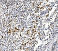 IHC staining of FFPE human lung cancer with POLR2A antibody. HIER: boil tissue sections in pH8 EDTA for 20 min and allow to cool before testing.