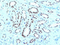 IHC testing of FFPE human renal cell carcinoma with PAX8 antibody cocktail (clone PAX8-1491 + PAX8/1492). Required HIER: boil tissue sections in 10mM Tris buffer with 1mM EDTA, pH 9, for 10-20 min followed by cooling at RT for 20 minutes.
