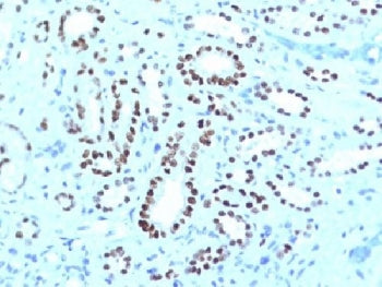 IHC testing of FFPE human renal cell carcinoma with PAX8 antibody cocktail (clone PAX8-1491 + PAX8/1492). Required HIER: boil tissue sections in 10mM Tris buffer with 1mM EDTA, pH 9, for 10-20 min followed by cooling at RT for 20 minutes.