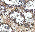 Immunohistochemical staining of MS4A4E using anti-MS4A4E antibody. MS4A4E was detected in a paraffin-embedded section of human prostate cancer tissue. Heat mediated antigen retrieval was performed in EDTA buffer (pH 8.0, epitope retrieval solution). The tissue section was blocked with 10% goat serum. The tissue section was then incubated with 2 ug/ml rabbit anti-MS4A4E antibody overnight at 4oC. Peroxidase Conjugated Goat Anti-rabbit IgG was used as secondary antibody and incubated for 30 min at 37oC.