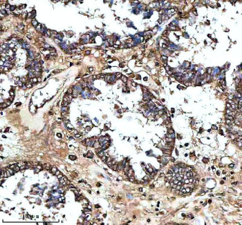 Immunohistochemical staining of MS4A4E using anti-MS4A4E antibody. MS4A4E was detected in a paraffin-embedded section of human prostate cancer tissue. Heat mediated antigen retrieval was performed in EDTA buffer (pH 8.0, epitope retrieval solution). The tissue section was blocked with 10% goat serum. The tissue section was then incubated with 2 ug/ml rabbit anti-MS4A4E antibody overnight at 4oC. Peroxidase Conjugated Goat Anti-rabbit IgG was used as secondary antibody and incubated for 30 min at 37oC.