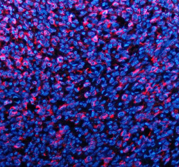 Immunofluorescent staining of TYRP1 using anti-TYRP1 antibody (red). TYRP1 was detected in a paraffin-embedded section of human melanoma tissue. Heat mediated antigen retrieval was performed in EDTA buffer (pH 8.0, epitope retrieval solution). The tissue section was blocked with 10% goat serum. The tissue section was then incubated with 5 ug/ml rabbit anti-TYRP1 antibody overnight at 4oC. Cy3 Conjugated Goat Anti-Rabbit IgG was used as secondary antibody at 1:500 dilution and incubated for 30 min at 37oC.