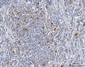 IHC staining of FFPE human lymphoma tissue with BCAT1 antibody. HIER: boil tissue sections in pH8 EDTA for 20 min and allow to cool before testing.