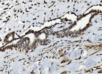 IHC staining of FFPE human breast cancer with Serum Response Factor antibody. HIER: boil tissue sections in pH8 EDTA for 20 min and allow to cool before testing.