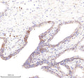 Immunohistochemical staining of POC1A using anti-POC1A antibody. POC1A was detected in a paraffin-embedded section of human prostate cancer tissue. Heat mediated antigen retrieval was performed in EDTA buffer (pH 8.0, epitope retrieval solution). The tissue section was blocked with 10% goat serum. The tissue section was then incubated with 2 ug/ml rabbit anti-POC1A antibody overnight at 4oC. Peroxidase Conjugated Goat Anti-rabbit IgG was used as secondary antibody and incubated for 30 min at 37oC.