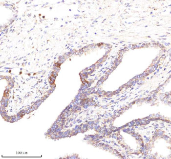 Immunohistochemical staining of POC1A using anti-POC1A antibody. POC1A was detected in a paraffin-embedded section of human prostate cancer tissue. Heat mediated antigen retrieval was performed in EDTA buffer (pH 8.0, epitope retrieval solution). The tissue section was blocked with 10% goat serum. The tissue section was then incubated with 2 ug/ml rabbit anti-POC1A antibody overnight at 4oC. Peroxidase Conjugated Goat Anti-rabbit IgG was used as secondary antibody and incubated for 30 min at 37oC.
