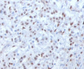 IHC testing of FFPE human mesothelioma with WT1 antibody (clone WLMT1-1). Required HIER: boil tissue sections in pH 9 10mM Tris with 1mM EDTA for 10-20 min followed by cooling at RT for 20 min.