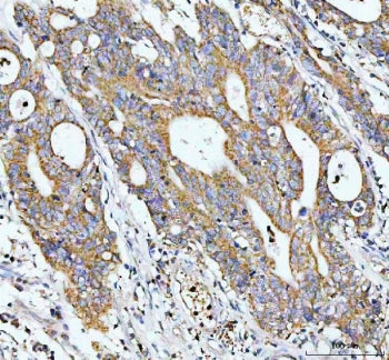 IHC staining of FFPE human colorectal cancer tissue with GCLC antibody. HIER: boil tissue sections in pH8 EDTA for 20 min and allow to cool before testing.