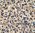 Immunohistochemical staining of QKI using anti-QKI antibody. QKI was detected in a paraffin-embedded section of human bladder cancer tissue. Heat mediated antigen retrieval was performed in EDTA buffer (pH 8.0, epitope retrieval solution). The tissue section was blocked with 10% goat serum. The tissue section was then incubated with 2 ug/ml rabbit anti-QKI antibody overnight at 4oC. Peroxidase Conjugated Goat Anti-rabbit IgG was used as secondary antibody and incubated for 30 min at 37oC.