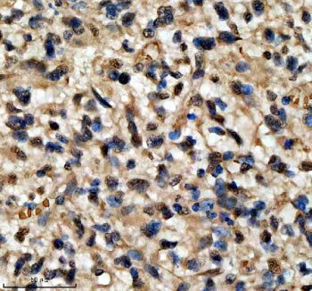 Immunohistochemical staining of QKI using anti-QKI antibody. QKI was detected in a paraffin-embedded section of human bladder cancer tissue. Heat mediated antigen retrieval was performed in EDTA buffer (pH 8.0, epitope retrieval solution). The tissue section was blocked with 10% goat serum. The tissue section was then incubated with 2 ug/ml rabbit anti-QKI antibody overnight at 4oC. Peroxidase Conjugated Goat Anti-rabbit IgG was used as secondary antibody and incubated for 30 min at 37oC.