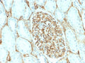 IHC testing of FFPE human renal cell carcinoma with recombinant CD34 antibody (clone HPCA1/2598R). Required HIER: boil tissue sections in 10mM Tris with 1mM EDTA, pH 9, for 10-20 min followed by cooling at RT for 20 min.