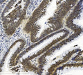 IHC staining of FFPE human low-differentiated adenocarcinoma with SMAD2 antibody. HIER: boil tissue sections in pH8 EDTA for 20 min and allow to cool before testing.
